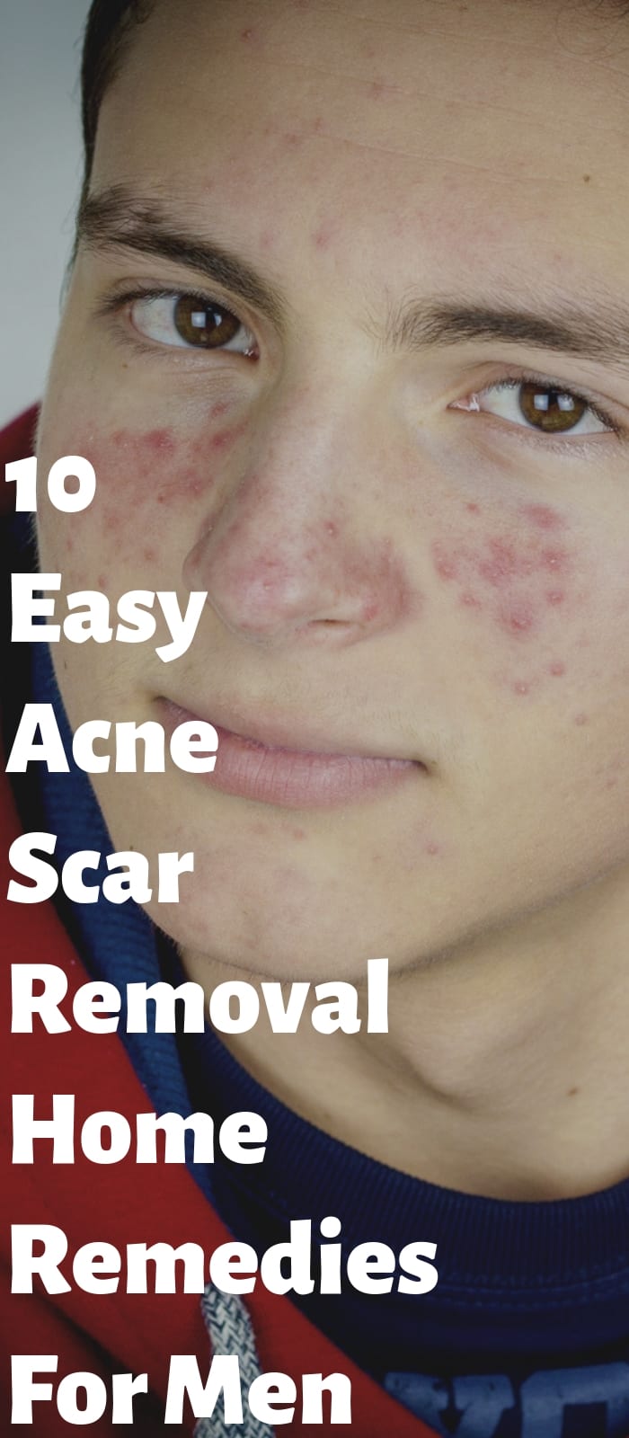 10 Easy Acne Scar Removal Home Remedies For Men!