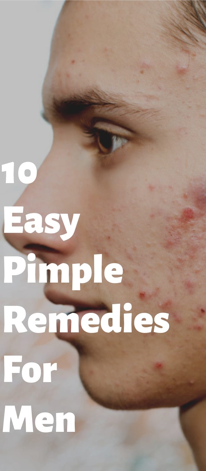 10 Simple Pimple Remedies For Men.